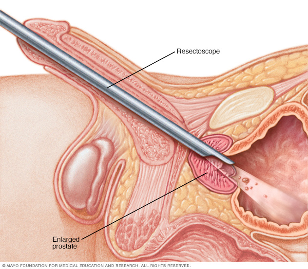 Illustration showing TURP procedure 
