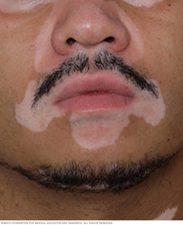 Vitiligo patches on the face