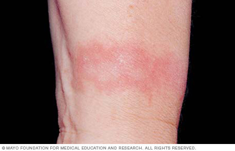 Contact dermatitis on the wrist