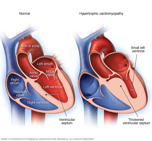 Normal heart and heart with hypertrophic cardiomyopathy