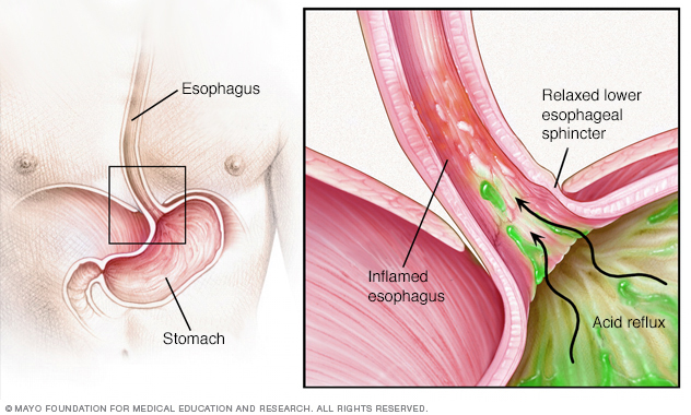 How GERD occurs in the esophagus 