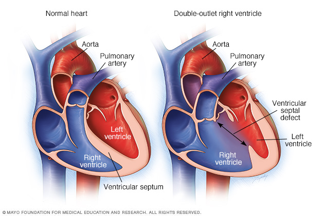 Normal heart and heart with double-outlet right ventricle