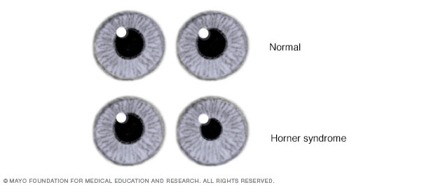 Horner syndrome signs