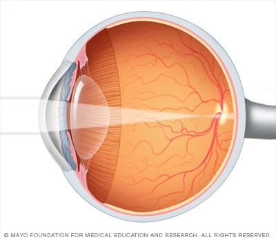 Nearsightedness (myopia)