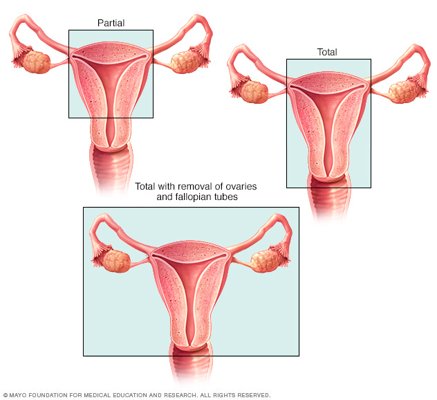 Types of hysterectomy surgery