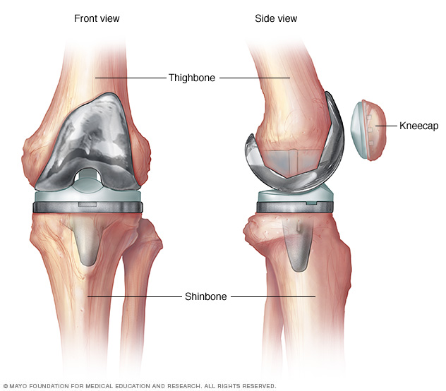 Illustration of an artificial knee 
