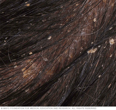 Seborrheic dermatitis of the scalp 