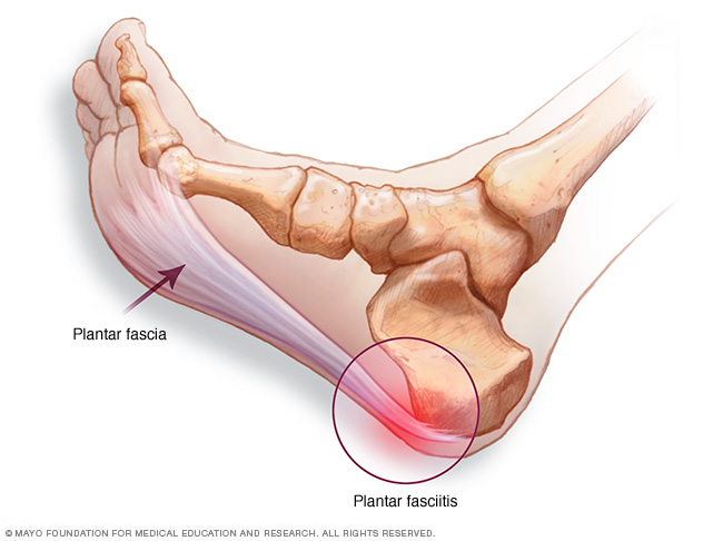 Plantar fascia and location of heel pain 