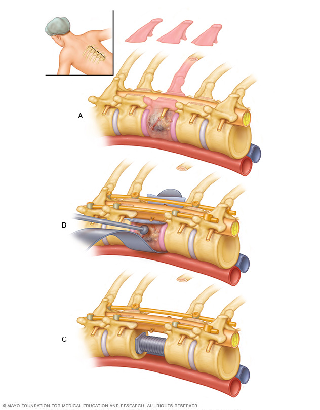 Surgical removal of vertebral metastatic tumor and stabilization.