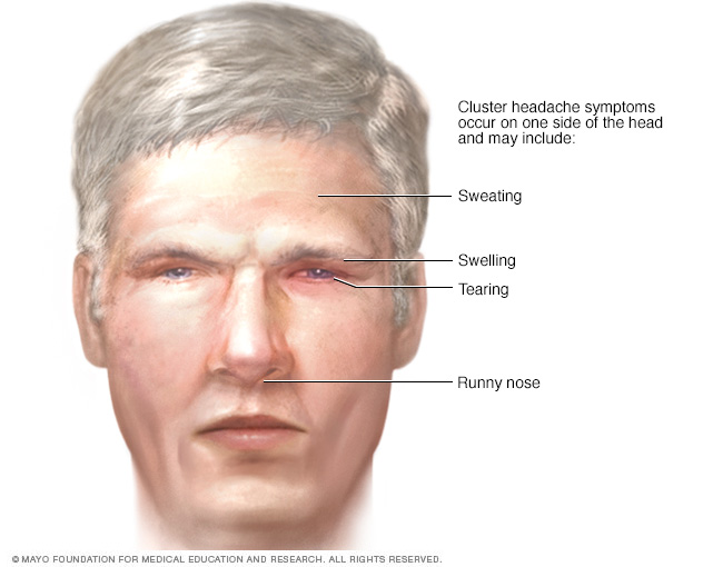 Cluster headache signs and symptoms  affecting the face