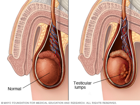 Image showing testicular lumps