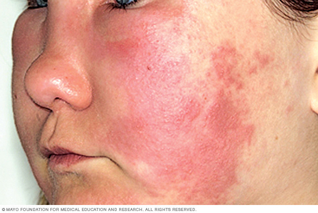 Angioedema causes swelling on the face.