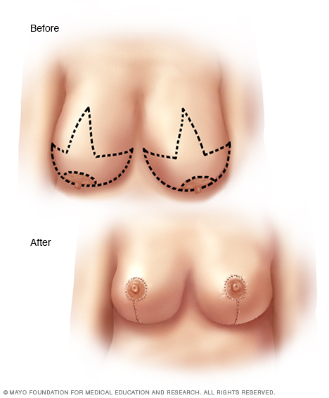 Incisions made for breast reduction surgery