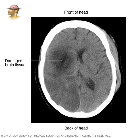 Brain tissue damaged by stroke