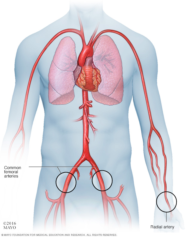 Illustration showing catheter approaches in a cardiac catheterization
