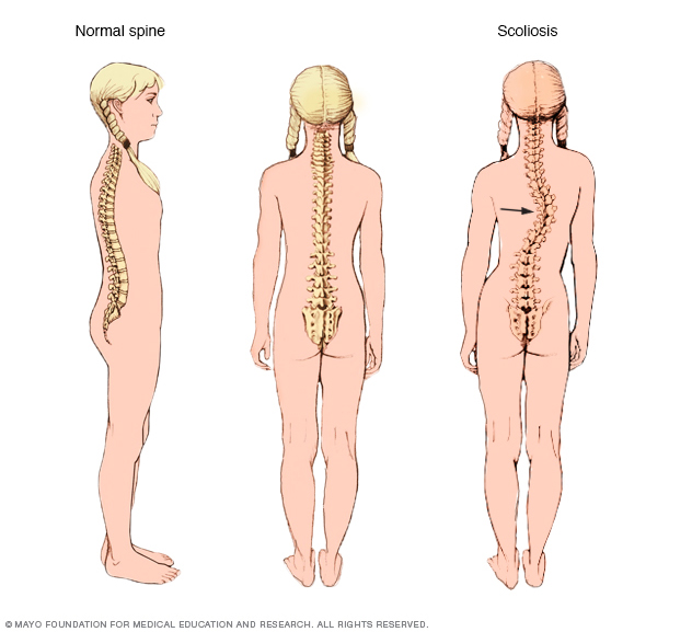 Comparing normal curves in spine with scoliosis