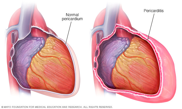A heart with pericarditis and a normal heart