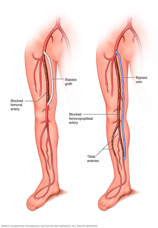 Graft bypass for peripheral artery disease