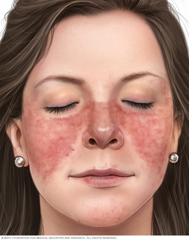 Illustration showing red, butterfly-shaped rash on nose and cheeks