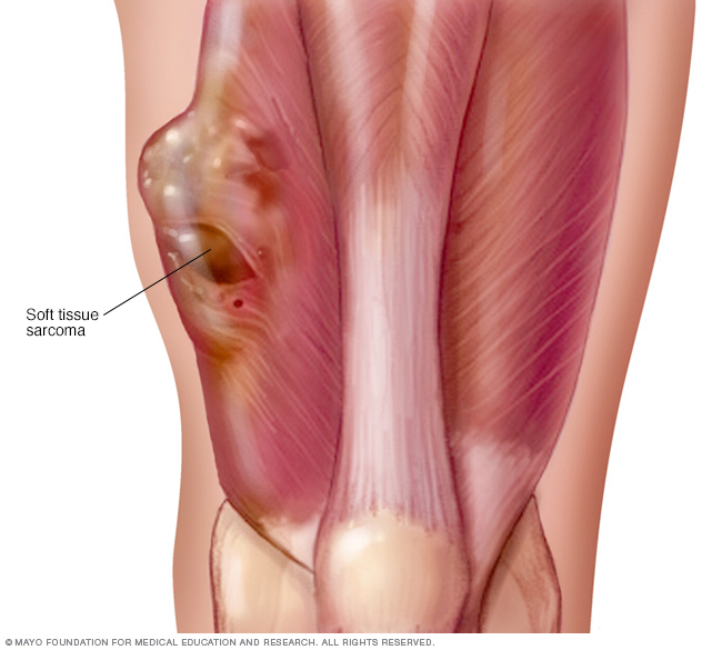 Tumor in thigh muscle