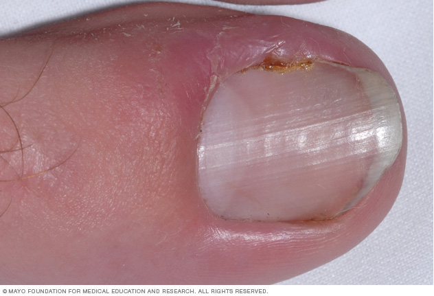 Photo showing an ingrown toenail
