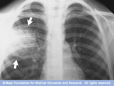 X-ray image of lungs with pneumonia