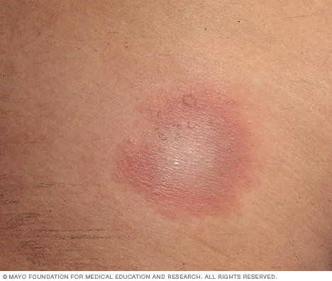 Bull's-eye rash characteristic of Lyme disease