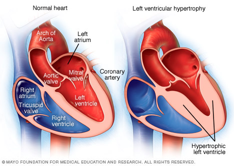 Illustration showing left ventricular hypertrophy