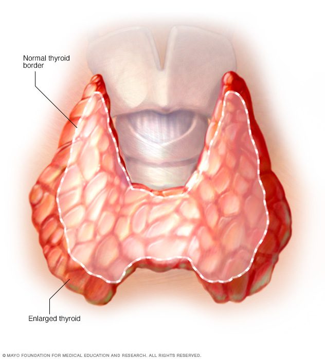 Enlarged thyroid associated with Graves' disease