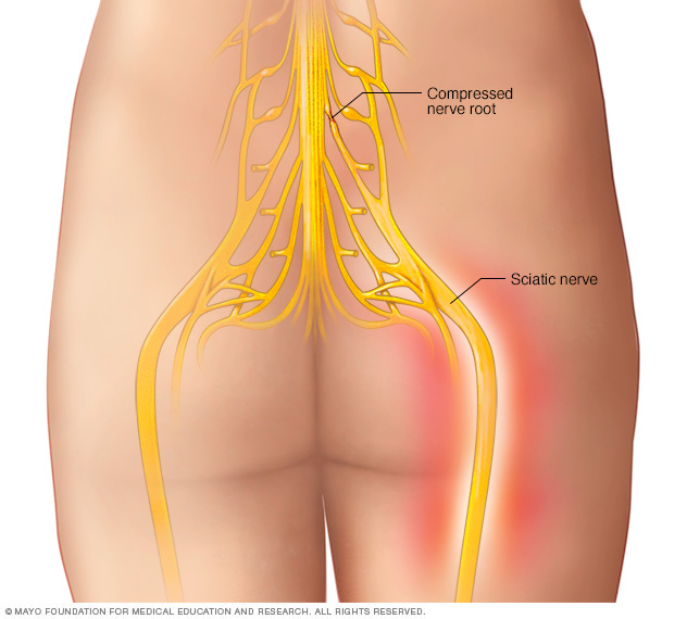 Illustration showing sciatic nerve 
