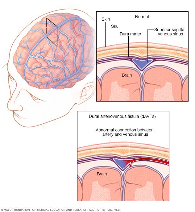 Dural arteriovenous fistula formation in the brain