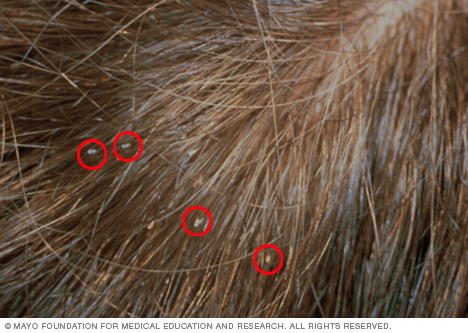 Head lice in hair