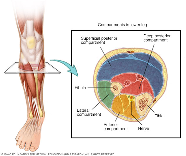 Chronic exertional compartment syndrome
