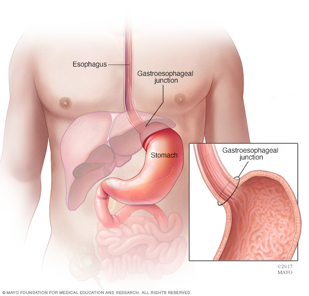 Esophagus, gastroesophageal junction and stomach
