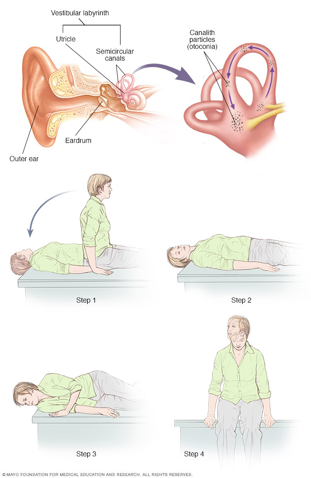 Canalith repositioning procedure