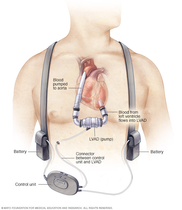 Left ventricular assist device (LVAD)