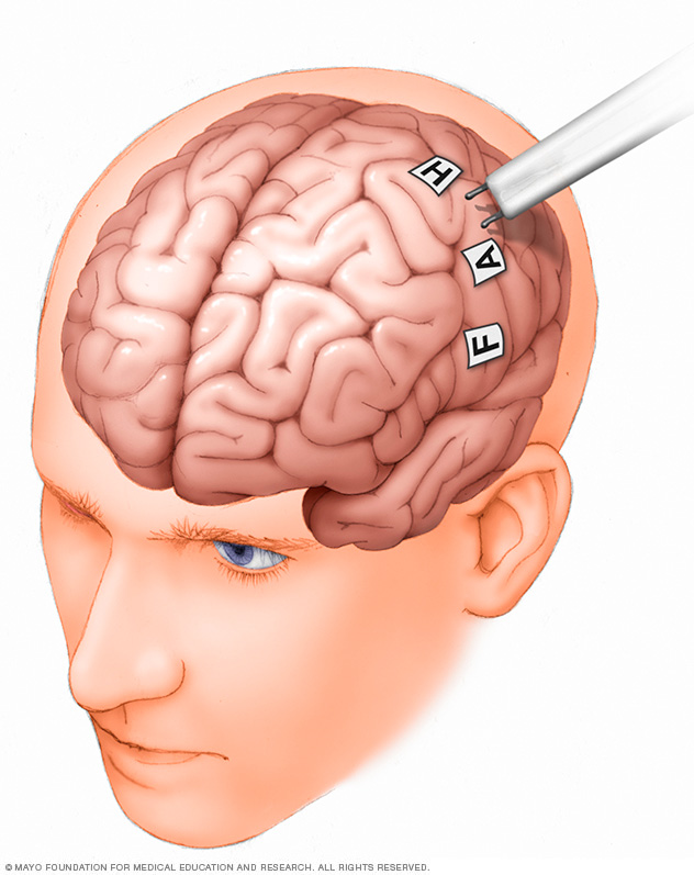 Brain mapping procedure