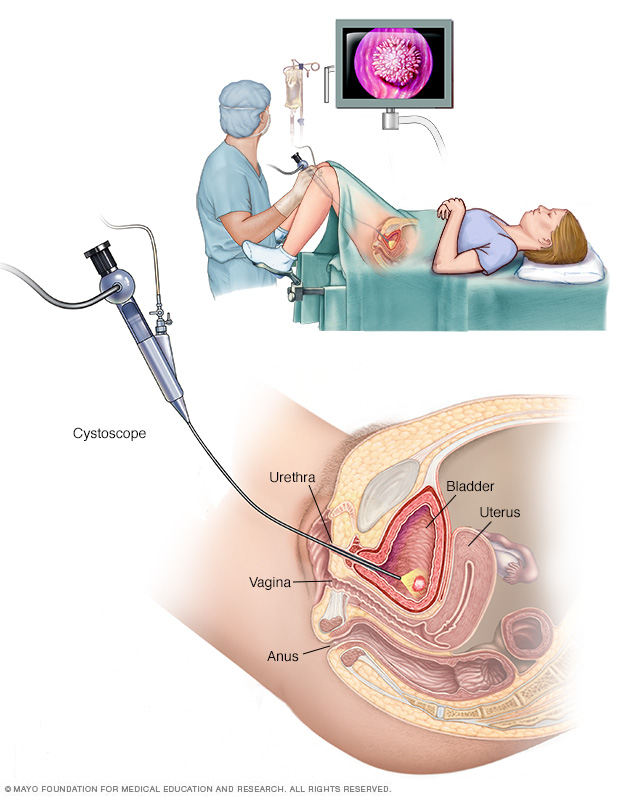 Cystoscopy performed on a woman