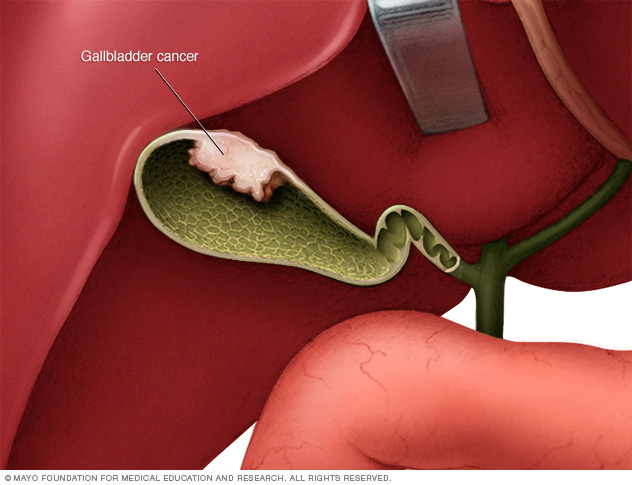 Gallbladder cancer
