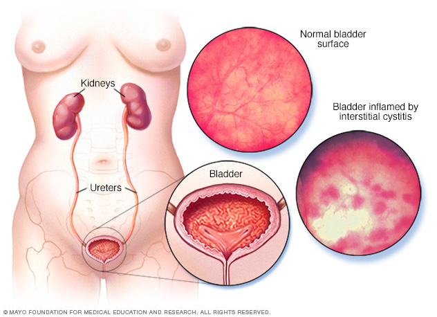 Illustration showing effect of interstitial cystitis on bladder