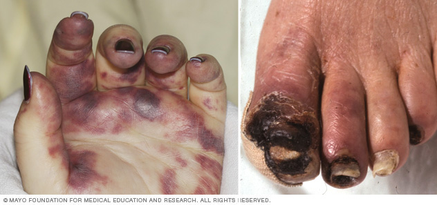 Images showing gangrene of the hand and foot