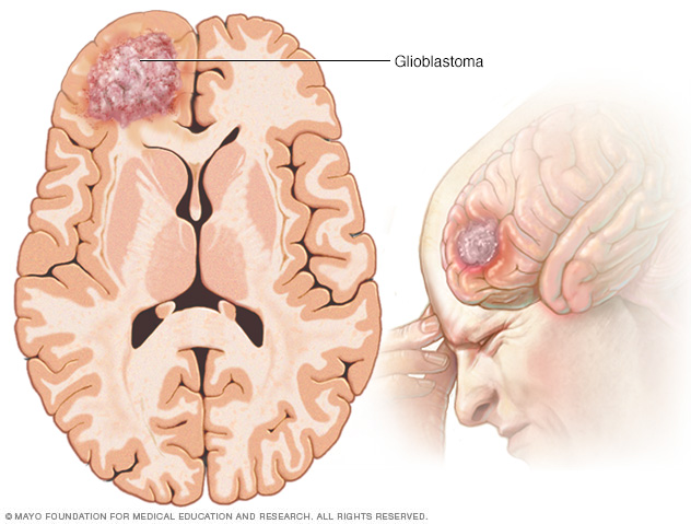 Glioblastoma brain tumor