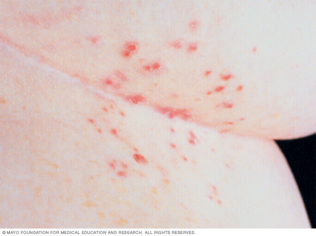 Scabies causes small raised blisters on the skin