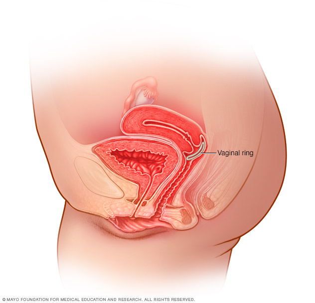 NuvaRing in place in the vagina